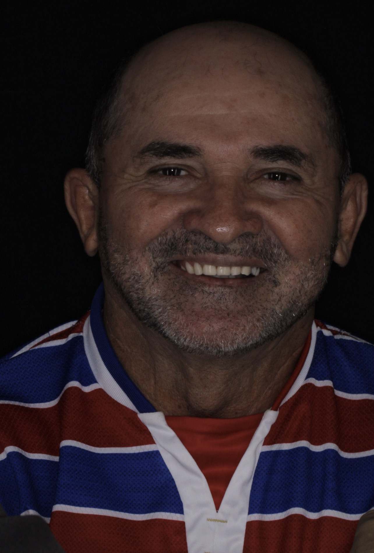 Reabilitação completa do sorriso — antes