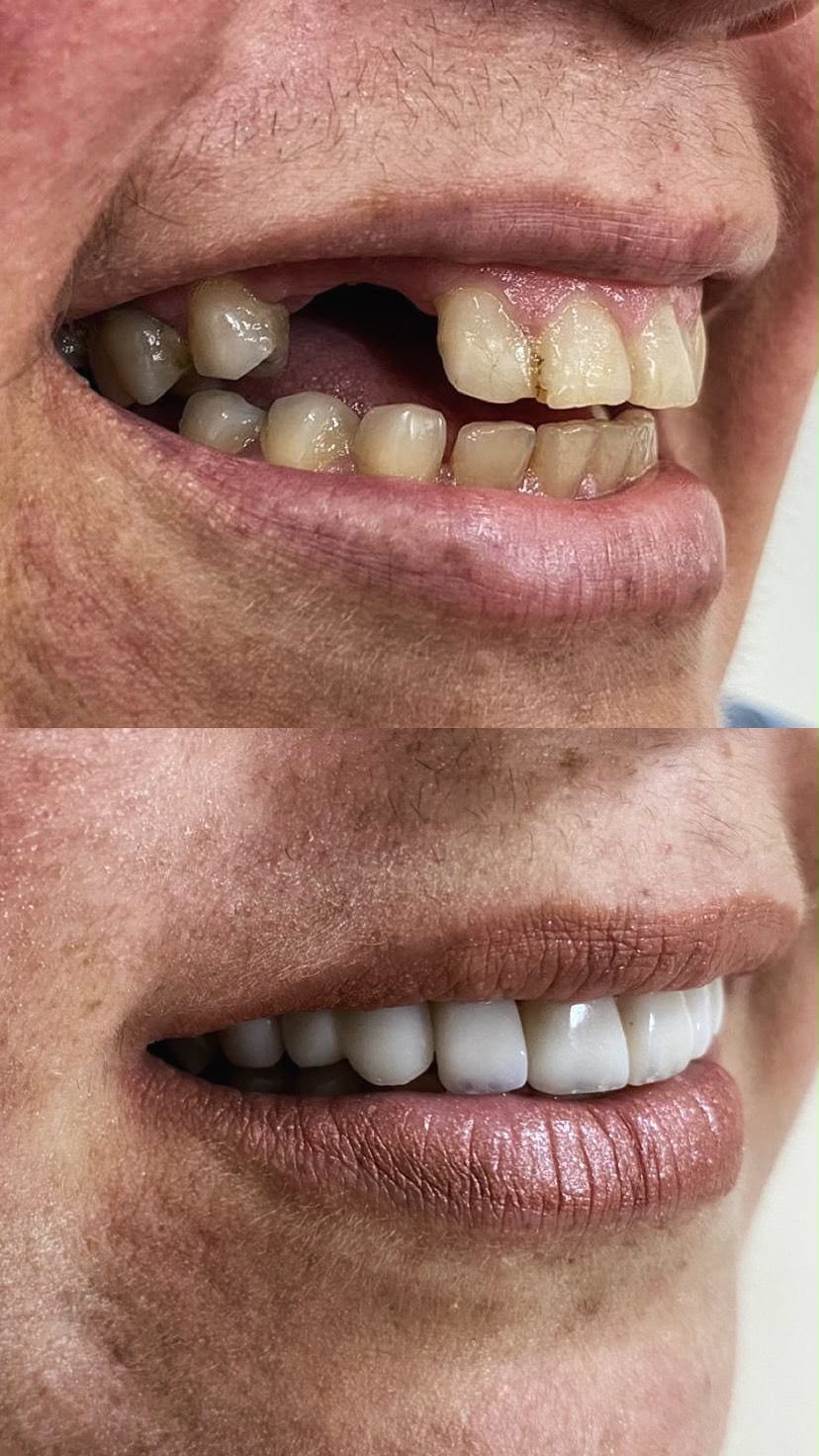 Implante e prótese sobre dente ausente — antes