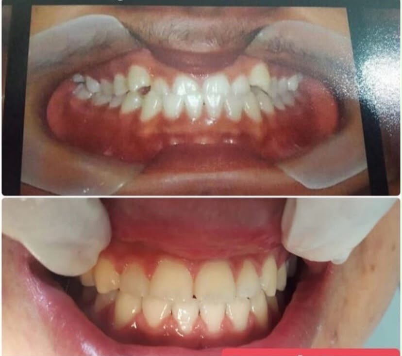 Mordida corrigida e sorriso alinhado